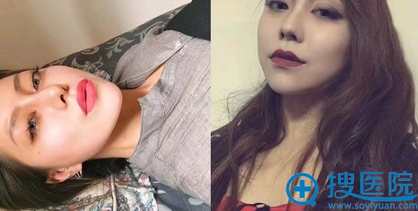 鼻综合和下巴整形第40天恢复效果 鼻综合和下巴整形第40天恢复效果