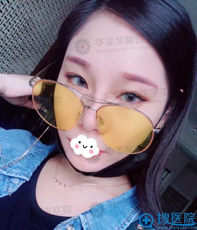 她到四川华美紫馨找杨力做下颌角手术5个月后竟然美的逆天!