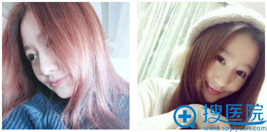 西安美莱房志强隆鼻一个月自拍 西安美莱房志强隆鼻一个月自拍