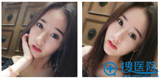 西安美莱房志强隆鼻3个月效果图 西安美莱房志强隆鼻3个月效果图