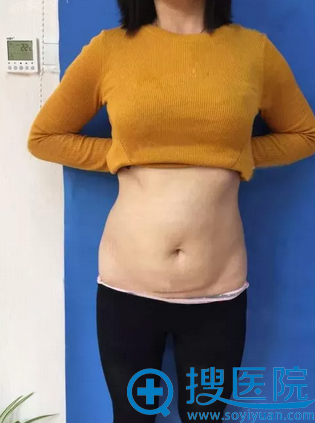 对比了济南美莱和海峡选择逄宝峰做的腰腹部抽脂术后恢复过程图