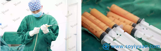 抽取大腿脂肪并提纯 抽取大腿脂肪并提纯