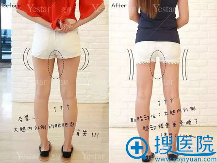 哈尔滨艺星大腿吸脂术后对比你效果 哈尔滨艺星大腿吸脂术后对比你效果