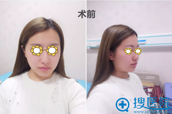 太原花妍膨体隆下巴+下颌缘吸脂真实经历及术后效果分享