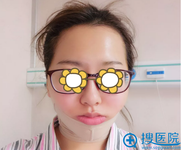 太原花妍下颌缘吸脂术后照 太原花妍下颌缘吸脂术后照