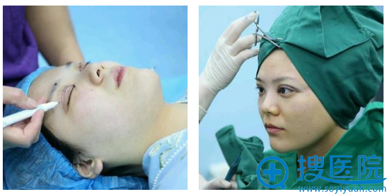 双眼皮术前及术后即刻效果 双眼皮术前及术后即刻效果