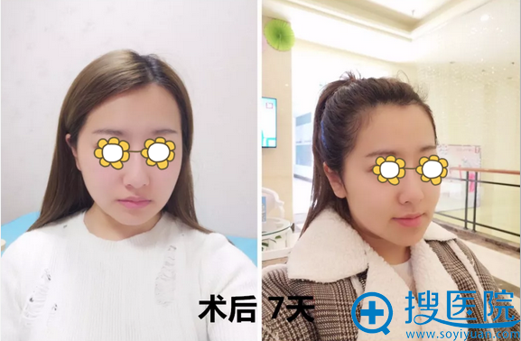 膨体隆下巴+吸脂术后7天对比照片 膨体隆下巴+吸脂术后7天对比照片