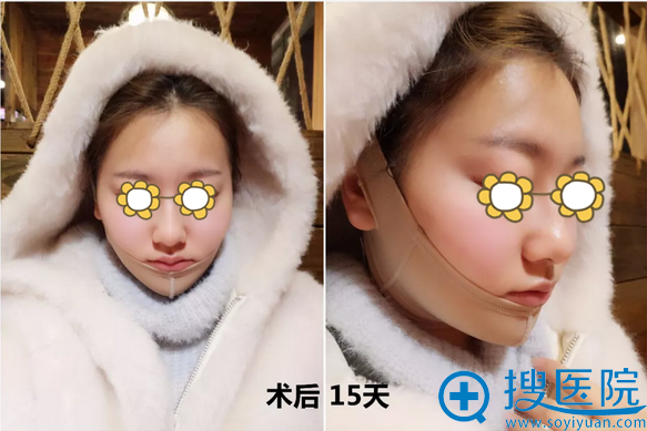 太原花妍下颌缘吸脂术后15天照片 太原花妍下颌缘吸脂术后15天照片