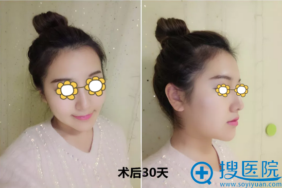 膨体隆下巴术后30天正面侧面照 膨体隆下巴术后30天正面侧面照