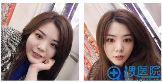 青岛壹美双眼皮1个月效果图 青岛壹美双眼皮1个月效果图