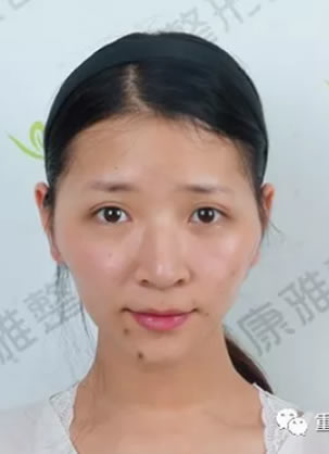 为了改善高颧骨克夫脸 在重庆康雅做SVR自体脂肪填充全面部手术