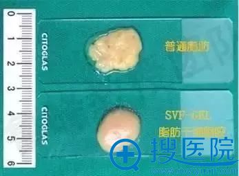 普通脂肪细胞和浓缩后的SVF-gel对比图 普通脂肪细胞和浓缩后的SVF-gel对比图