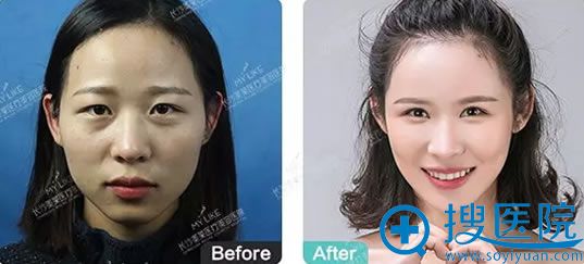 鲁峰医生自体脂肪填充面部案例图 鲁峰医生自体脂肪填充面部案例图
