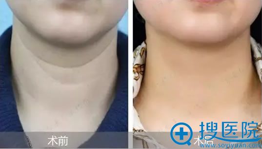 鲁峰教授的纳米脂肪注射治疗颈纹案例 鲁峰教授的纳米脂肪注射治疗颈纹案例
