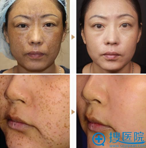 荆州华美皮秒激光祛斑真人案例 荆州华美皮秒激光祛斑真人案例