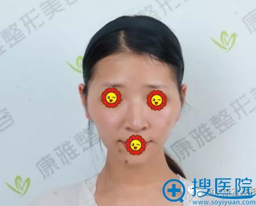 做自体脂肪填充全脸前高颧骨照片 做自体脂肪填充全脸前高颧骨照片