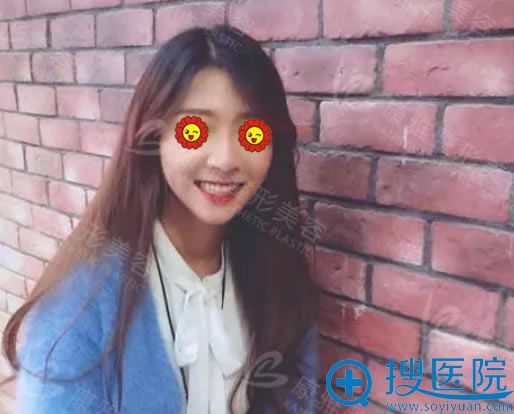 自体脂肪填充全脸第7天恢复照 自体脂肪填充全脸第7天恢复照