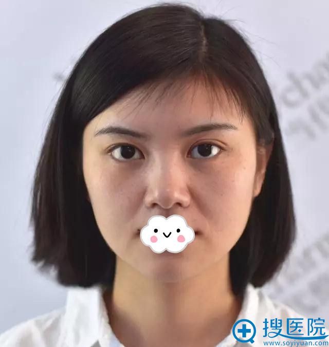 重庆当代祛斑怎么样?看她花1980元让郭小琴为她激光祛斑效果