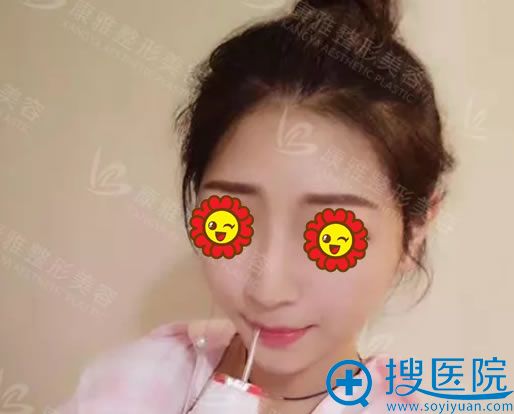 高颧骨做自体脂肪填充1个月效果 高颧骨做自体脂肪填充1个月效果