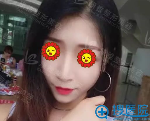 自体脂肪填充手术2个月恢复照 自体脂肪填充手术2个月恢复照