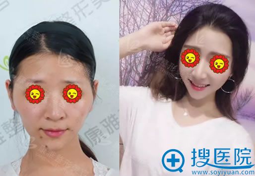 <!--<i data=20240710 data-id=12505></i>-->脂肪填充案例对比图 <!--<i data=20240710 data-id=12505></i>-->脂肪填充案例对比图