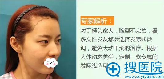 发际线种植前照片 发际线种植前照片