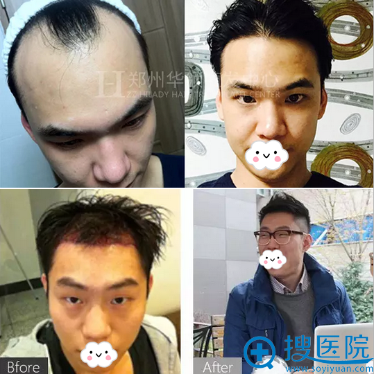 郑州华领发际线种植案例 郑州华领发际线种植案例