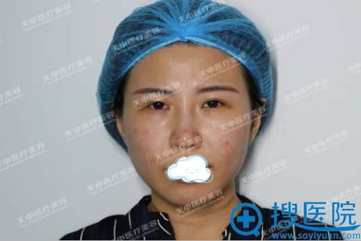 武汉天申整形美容医院面部埋线提升做的值不值 她的颜值来说话