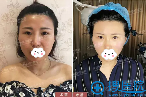 武汉天申埋线提升术后即刻对比照 武汉天申埋线提升术后即刻对比照