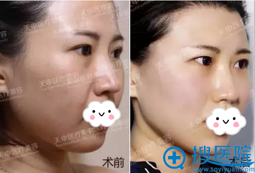 武汉天申逆龄面雕术后皮肤对比情况 武汉天申逆龄面雕术后皮肤对比情况