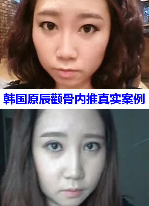 对比了磨骨和脂肪填充 选择韩国原辰整形医院做了颧骨内推手术