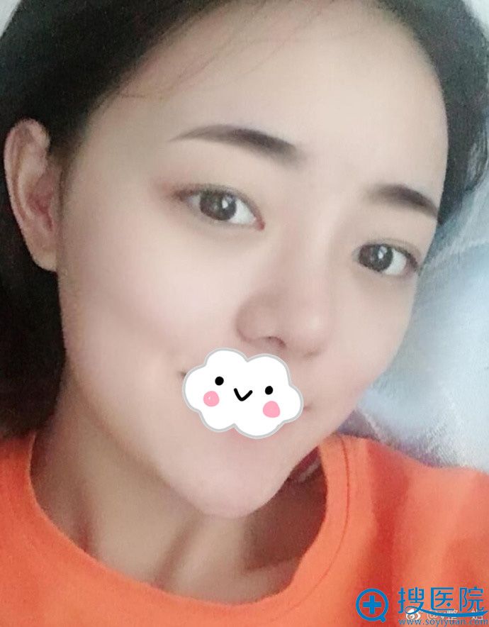 武汉新至美聂祝锋好吗?为我做了自体脂肪面部填充后脸变这样