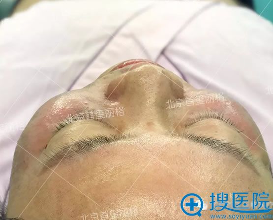 悦升线埋线提升手术即刻效果图 悦升线埋线提升手术即刻效果图