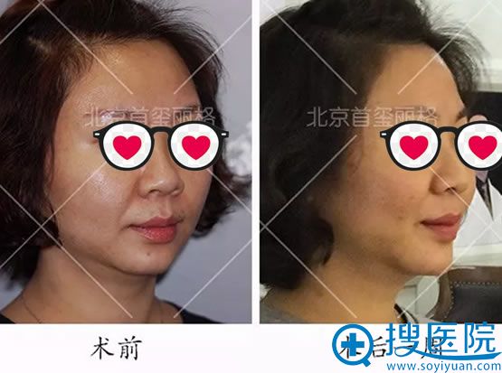 面部线雕手术一周前后效果对比图 面部线雕手术一周前后效果对比图