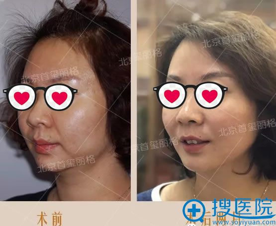 <!--<i data=20240710 data-id=7739></i>-->韩用线雕案例2个月效果 <!--<i data=20240710 data-id=7739></i>-->韩用线雕案例2个月效果