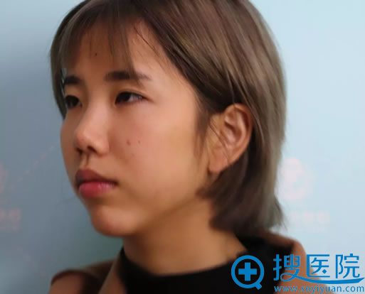 做眼鼻综合整形手术前的照片 做眼鼻综合整形手术前的照片