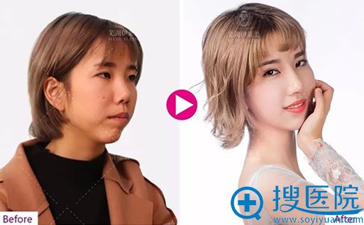 芜湖伊莱美鼻综合案例效果对比图 芜湖伊莱美鼻综合案例效果对比图