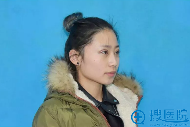 <!--<i data=20240710 data-id=12335></i>-->双眼皮手术第1天 <!--<i data=20240710 data-id=12335></i>-->双眼皮手术第1天