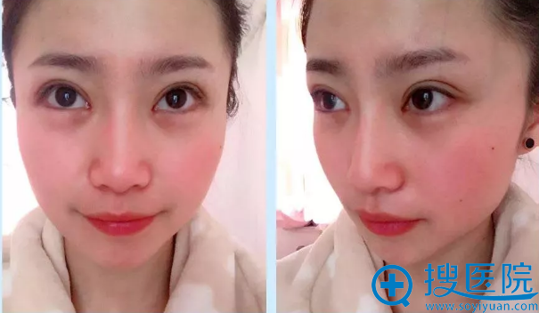 做双眼皮手术第7天恢复效果图 做双眼皮手术第7天恢复效果图