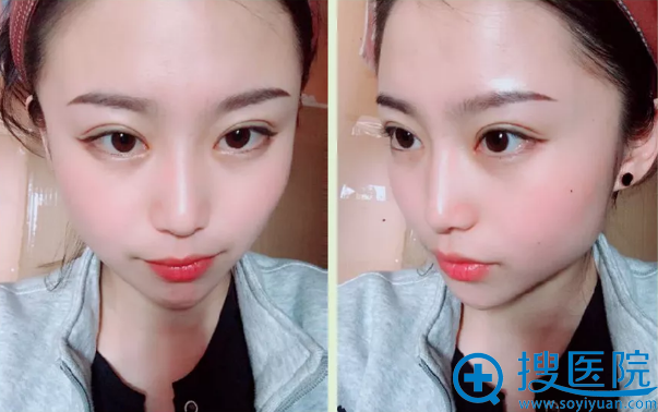 双眼皮手术第30天恢复图片 双眼皮手术第30天恢复图片