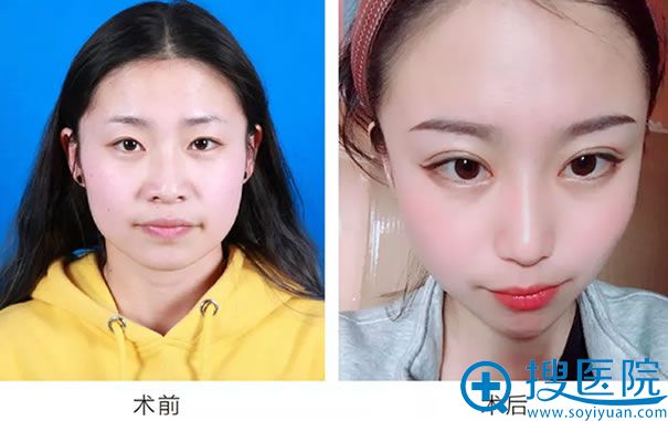 <!--<i data=20240710 data-id=12335></i>-->李敦艳院长双眼皮案例对比图 <!--<i data=20240710 data-id=12335></i>-->李敦艳院长双眼皮案例对比图