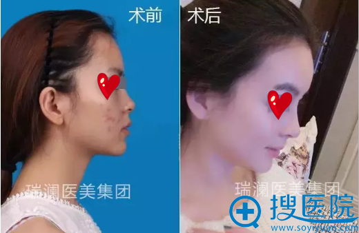 长沙瑞澜假体综合隆鼻手术前后45天的变化,把周围人都惊呆了