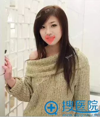 <!--<i data=20240710 data-id=1951></i>-->假体隆鼻术后一周效果 <!--<i data=20240710 data-id=1951></i>-->假体隆鼻术后一周效果