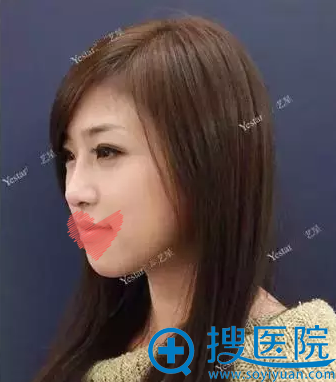 假体隆鼻术后一周侧面照 假体隆鼻术后一周侧面照