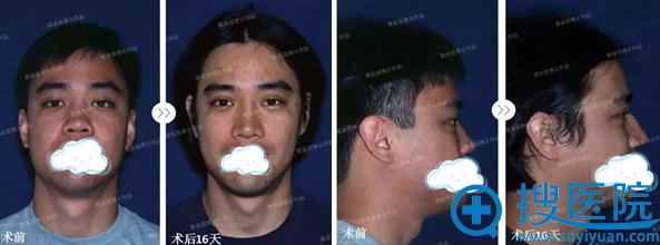 黄金龙隆鼻手术前后对比照片 黄金龙隆鼻手术前后对比照片