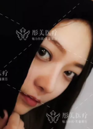 跟风闺蜜选择北京彤美李长赋院长做肋软骨鼻综合手术升级高级脸