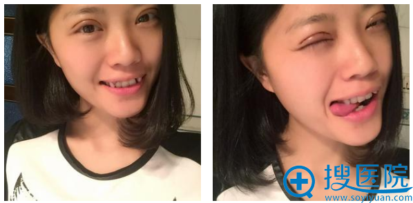 贵阳华美双眼皮6天自拍 贵阳华美双眼皮6天自拍