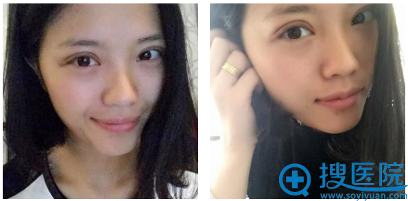 今天去贵阳华美拆线了 今天去贵阳华美拆线了