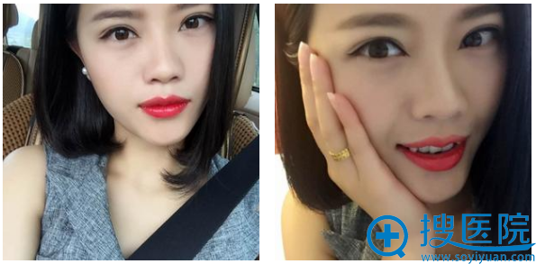 贵阳华美韩胜斌做的双眼皮案例20天效果 贵阳华美韩胜斌做的双眼皮案例20天效果