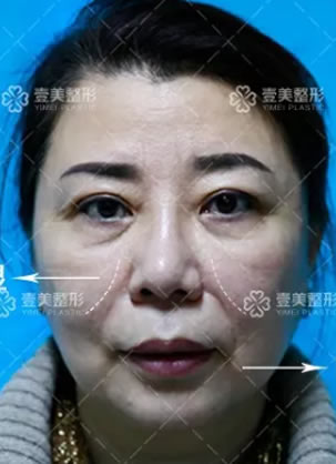 带老妈体验一把淄博壹美整形医院曹东亚V颜面部线雕抗衰效果